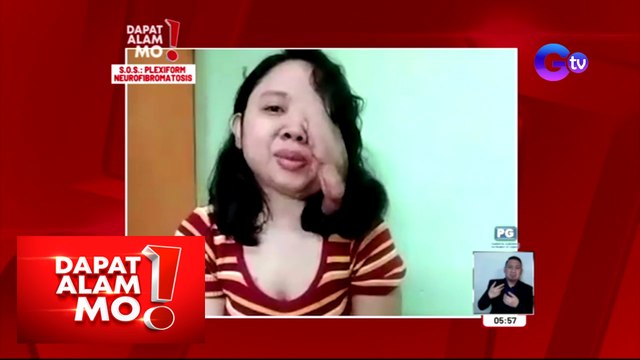 Dapat Alam Mo!: Inaakalang kuliti at lumalaking eye bags, senyales pala ng karamdaman?