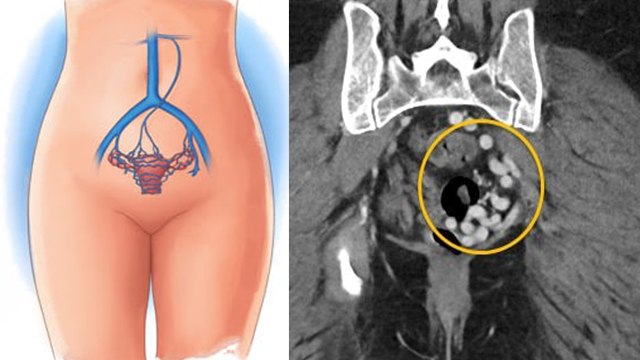 पेट के निचले हिस्से में दर्द का कारण, हर महिला जानें Pelvic Congestion Syndrome क्या है | Boldsky