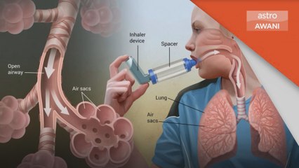 Hari Asma Sedunia | Pesakit disaran terus bersukan, ikuti tekniknya
