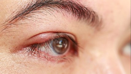 bd-causas-y-tratamientos-de-orzuelos-240322