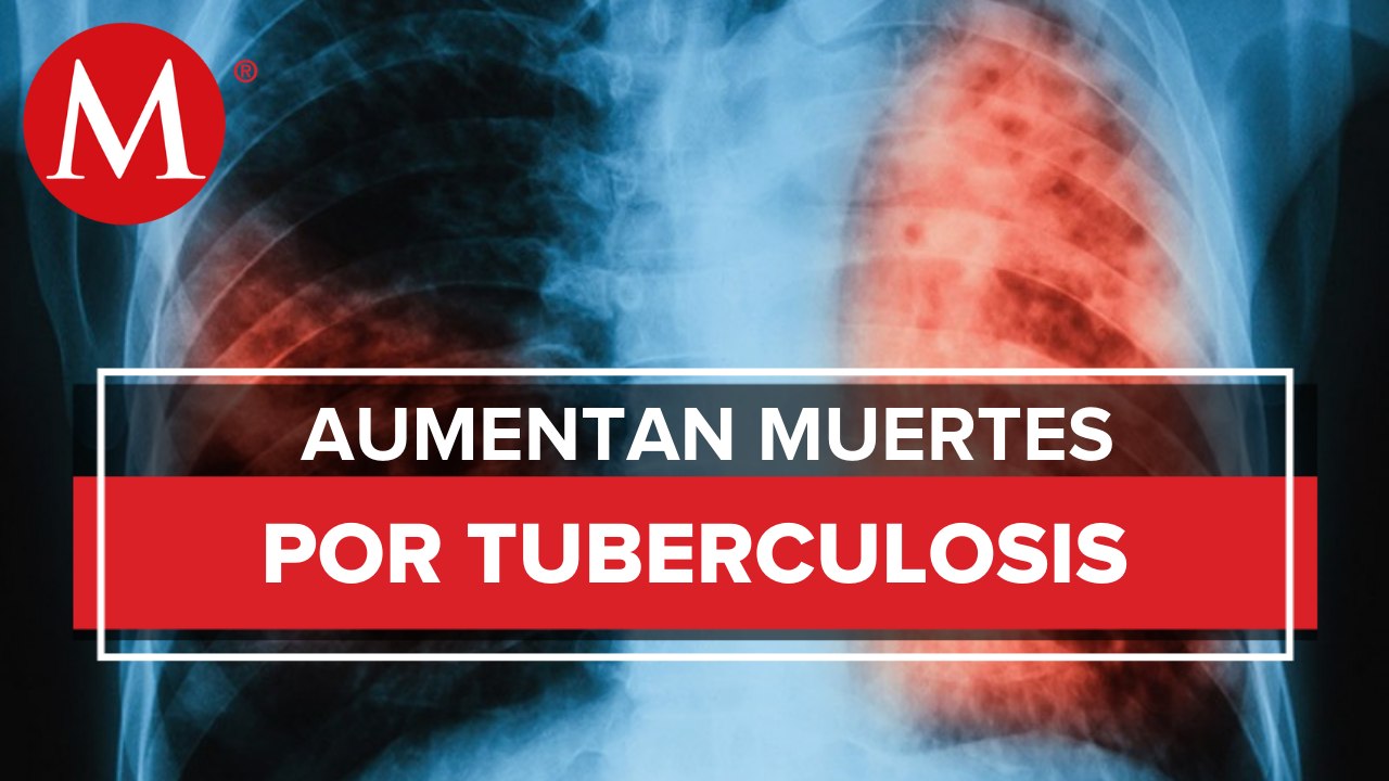 Día Mundial de la Tuberculosis: Qué es, síntomas, Tratamiento y cómo prevenirla