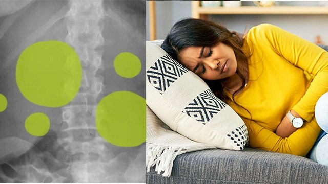 पेट में गैस क्यों फंसती है | पेट में गैस फंसने का कारण | Pet Me Gas Fas Jaye To Kya Kare | Boldsky