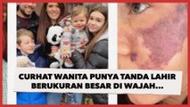 Punya Tanda Lahir Berukuran Besar di Wajah, Curhat Wanita Soal Penampilannya di Depan Tunangan