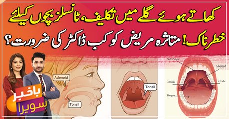 Download Video: What are Tonsil Stones? Causes, symptoms and treatments