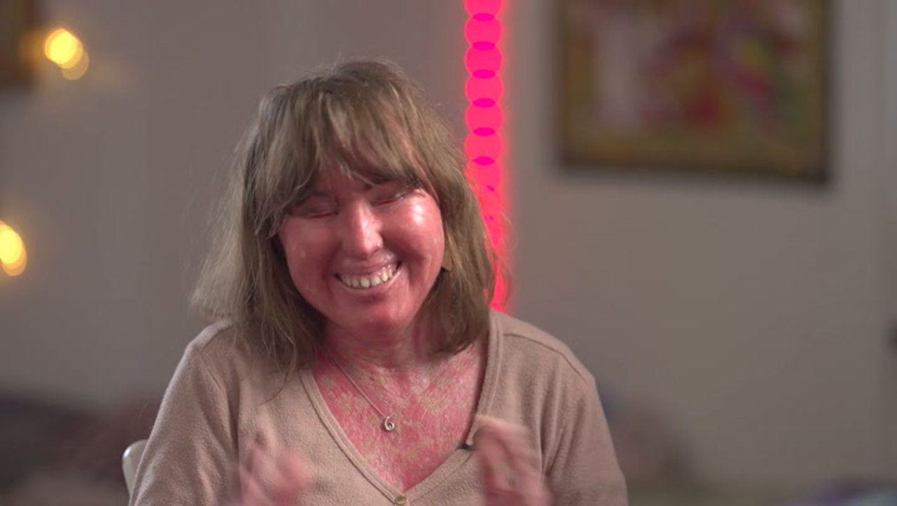 Will My Blind Date Look Past My Skin Condition? | DATING DIFFERENT