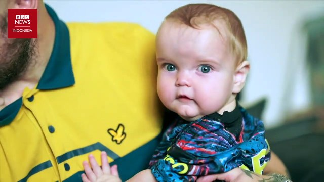 Teknologi Medis Terbaru: Operasi Tulang Tengkorak Bayi dengan Realitas Virtual