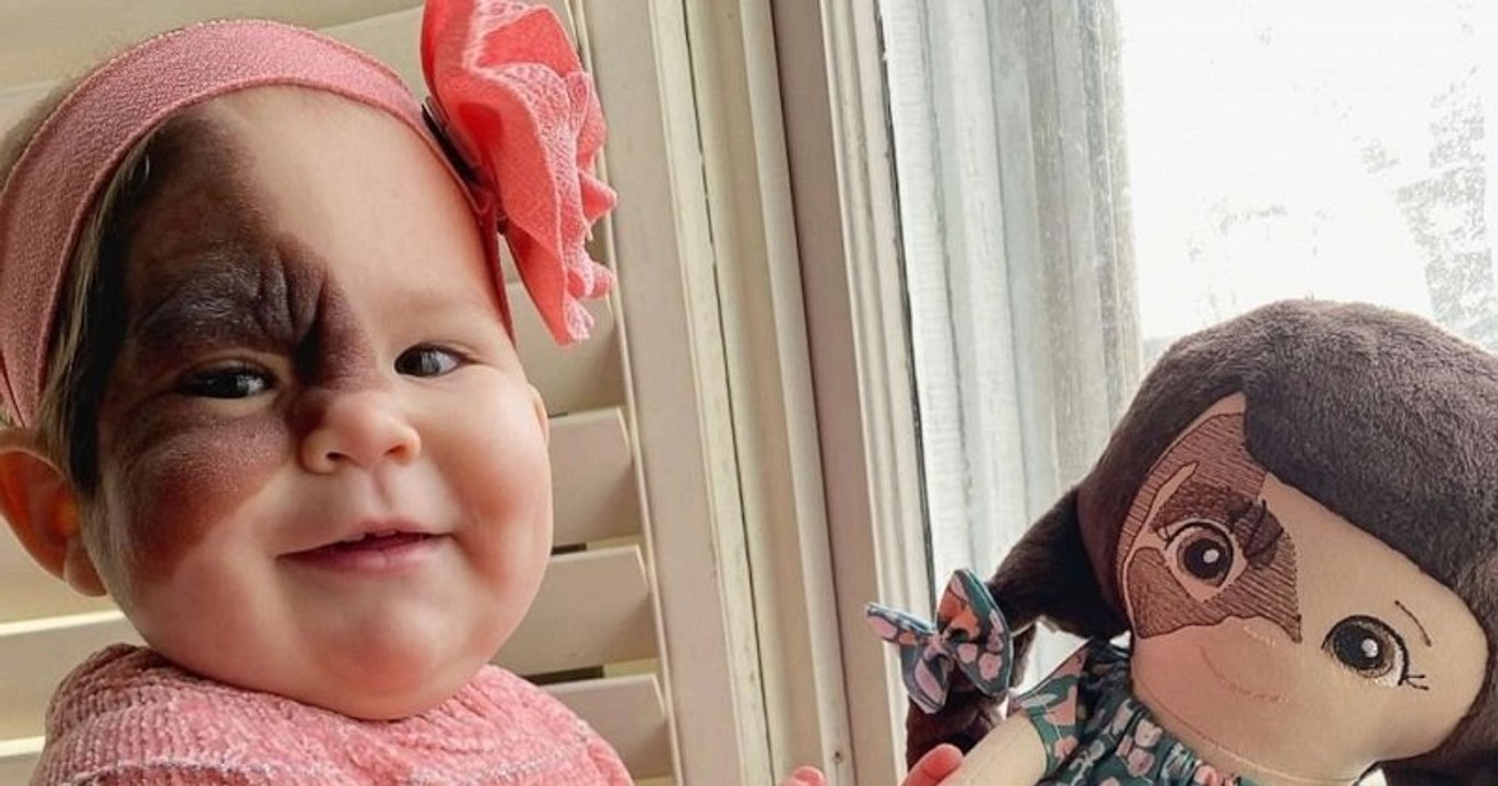 Une maman veut montrer que sa fille est belle malgré sa tache de naissance sur le visage
