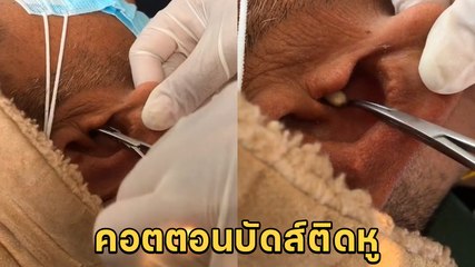 อุทาหรณ์ ! ใช้คอตตอนบัดปั่นหูพลาด สำลีหลุดจากก้านติดคารูหู
