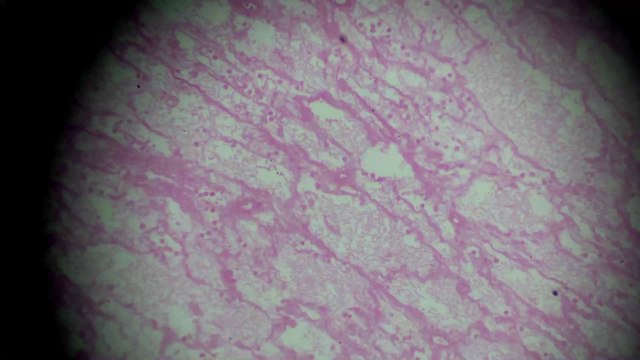 Maladie de Waldenström : symptômes, causes, traitement, de quoi s'agit-il ?