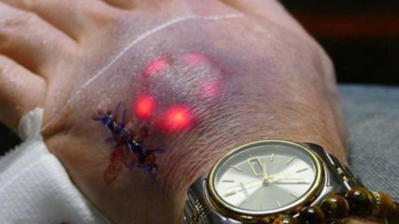 Northstar V1: Schluss mit Tattoos, jetzt kommen LEDs unter die Haut!