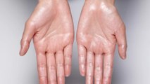 Sweaty hands: These common household items will keep your palms fresh and dry