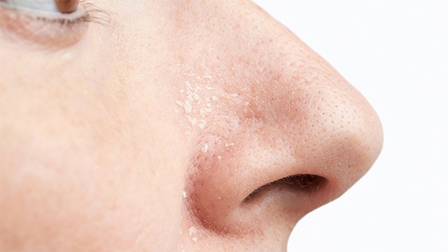 नाक के आसपास ड्राई स्किन क्यों होती है | Naak Ke Pass Dry Skin Kyu Hoti Hai | Boldsky