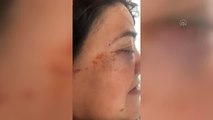 Son dakika haberleri | Silah sesi üzerine pencereden başını uzatan kadın gözünden vuruldu (2)