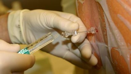 Ponction lombaire : douleur, technique, complications, de quoi s’agit-il ?