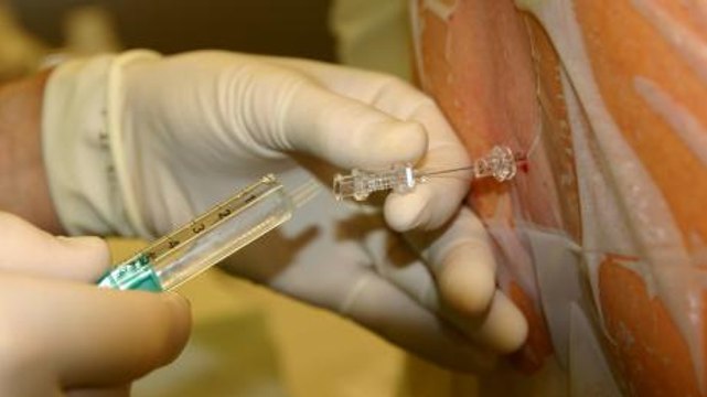 Ponction lombaire : douleur, technique, complications, de quoi s’agit-il ?