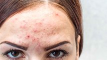 Eyebrow के बीच में Acne का Cause, इस Remedy से मिलेगा छुटकारा | Boldsky