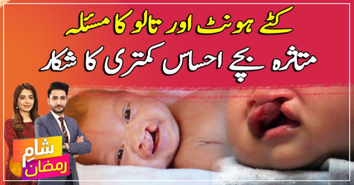 Guidelines for children suffering from Cleft Lips and Palates problem