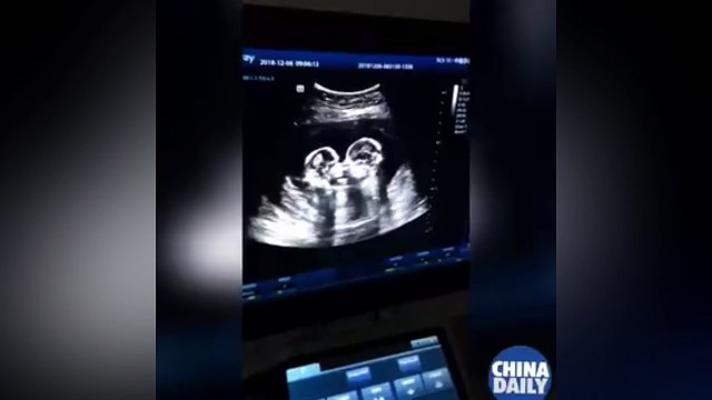 Des jumelles surprises en train de se disputer dans le ventre de maman