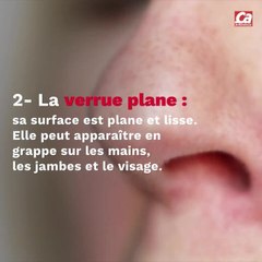 CAM - Tout savoir sur les verrues.