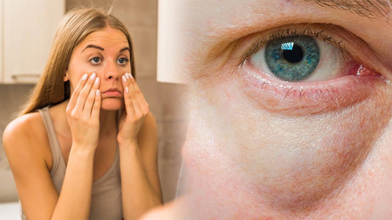 सुबह उठने पर Eye Swelling क्यों होती है | आंखो में सूजन के कारण | Boldsky
