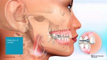 Shorter Animation Motion 3D and Aligners | Vacaville CA