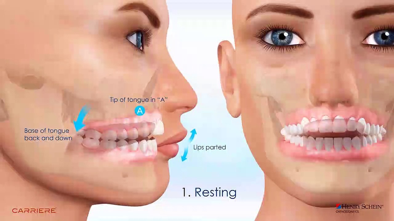 Open Bite Correction with Motion 3D Clear and Aligners | Vacaville CA