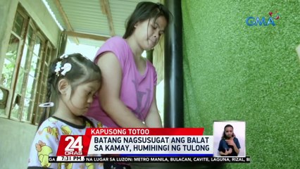 Batang nagsusugat ang balat sa kamay, humihingi ng tulong | 24 Oras
