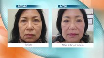 Face lift results without the downtime at VitalityMDs Aesthetics