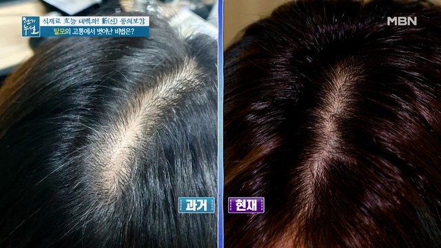 충격적인 BEFORE & AFTER! 30대에 찾아온 심각한 탈모