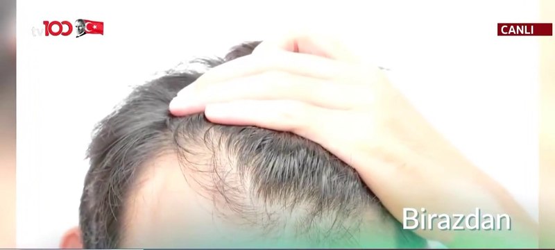 Saç egzaması nedir? Saçlar neden dökülür ?