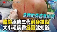 體驗祖傳三代刮痧技術 大小毛病看痧圖就知道