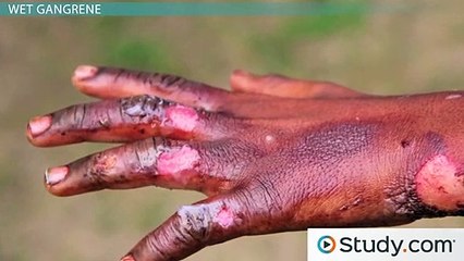 Gangrene- Signs & Treatment
