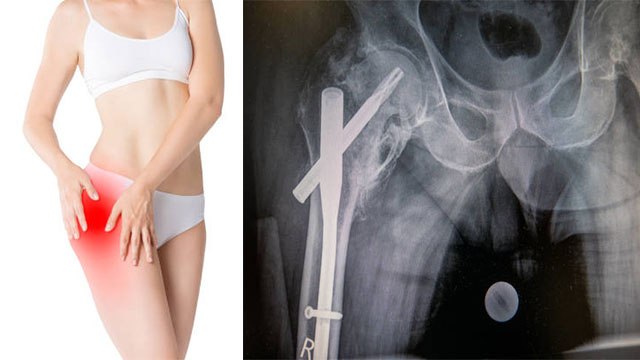 Upper Thigh Pain क्यों होता है | जांघ के ऊपरी हिस्से में दर्द को न करें नजरंदाज | Boldsky