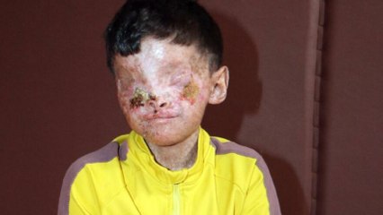 Gözleri kapanan cilt kanseri Salih: Ailemi merak ediyorum, bisiklet sürmek istiyorum