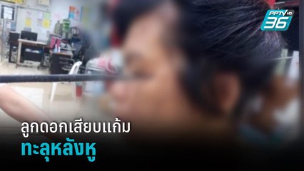 หวาดเสียว หญิงถูกลูกดอกเสียบแก้มทะลุหลังหู | โชว์ข่าวเช้านี้