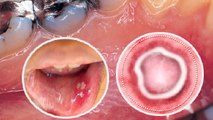 मुंह में सफेद दाग होना Mouth Cancer Symptoms, तुरंत कराए जांच Watch Video | Boldsky