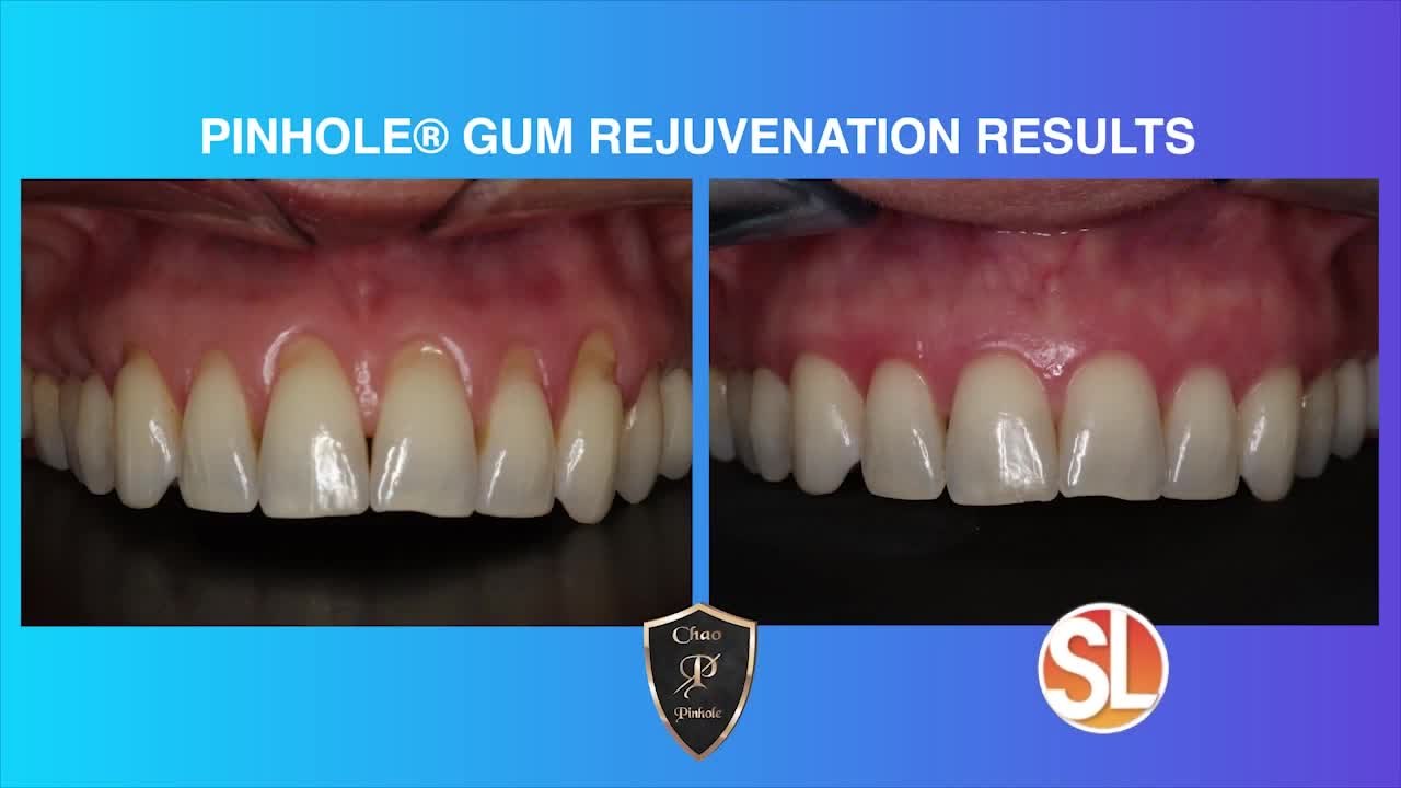 Sal Gaytan, Director of the Pinhole Academy ​for "Pinhole Gum Rejuvenation®" discusses gum rejuvenation