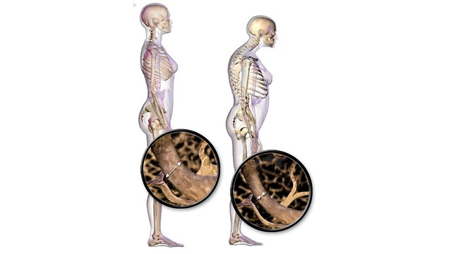bd-Osteoporosis en hombres: sus causas, síntomas y tratamientos-220422