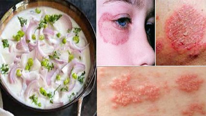 प्याज और दही साथ खाने से क्या होता है । प्याज और दही साथ खाने के नुकसान । Boldsky