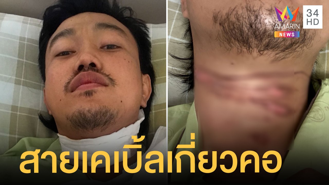 สายเคเบิ้ลเกี่ยว จยย.พุ่งอัดเสาไฟฟ้า หนุ่มเจ็บส...