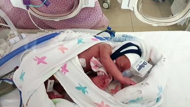 One of UK's tiniest babies born in Bristol weighing just 1lb 4oz