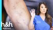 Tiene su brazo cubierto con cicatrices | Dra. Sandra Lee: Especialista en piel | Discovery H&H