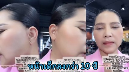 สุนารี อัปเดตศัลยกรรม แผลหายเกือบสนิท สวยขึ้นมาก แถมหน้าเด็กลงกว่า 10 ปี