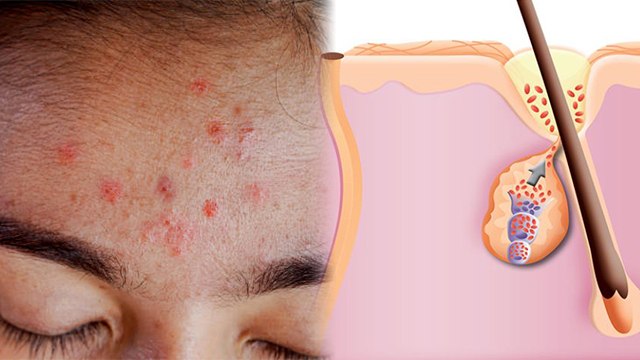 माथे पर दाने क्यों होते है | माथे पर दाने होने के कारण |Pimple On Forehead |Boldsky