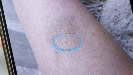 «J'ai senti des douleurs très intenses et une envie de dormir» : Rose, victime d’une piqûre sauvage en boîte de nuit