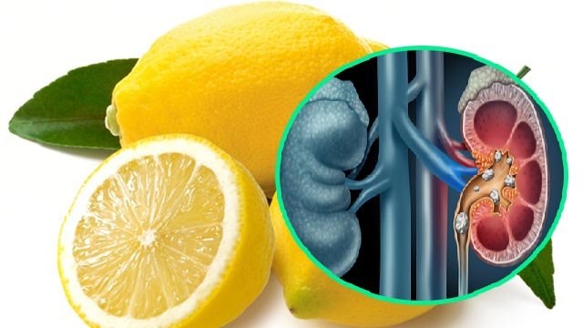 Kidney Stone का इलाज Lemon से हो सकता है क्या ? । Lemon Can Cure Kidney Stone | Boldsky