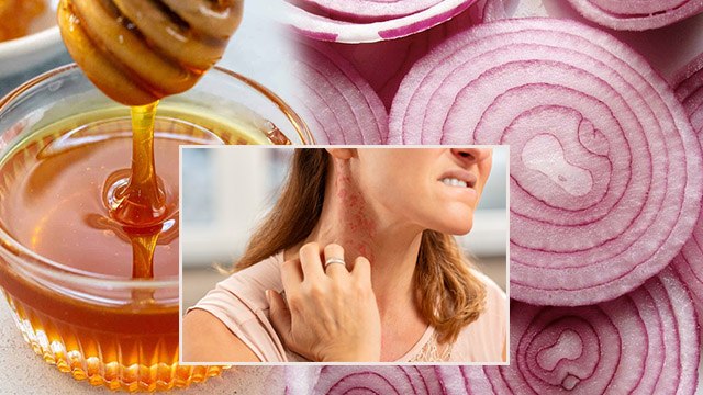 कच्चा प्याज और शहद खाने से क्या होता है । कच्चा प्याज और शहद खाने के नुकसान । Boldsky