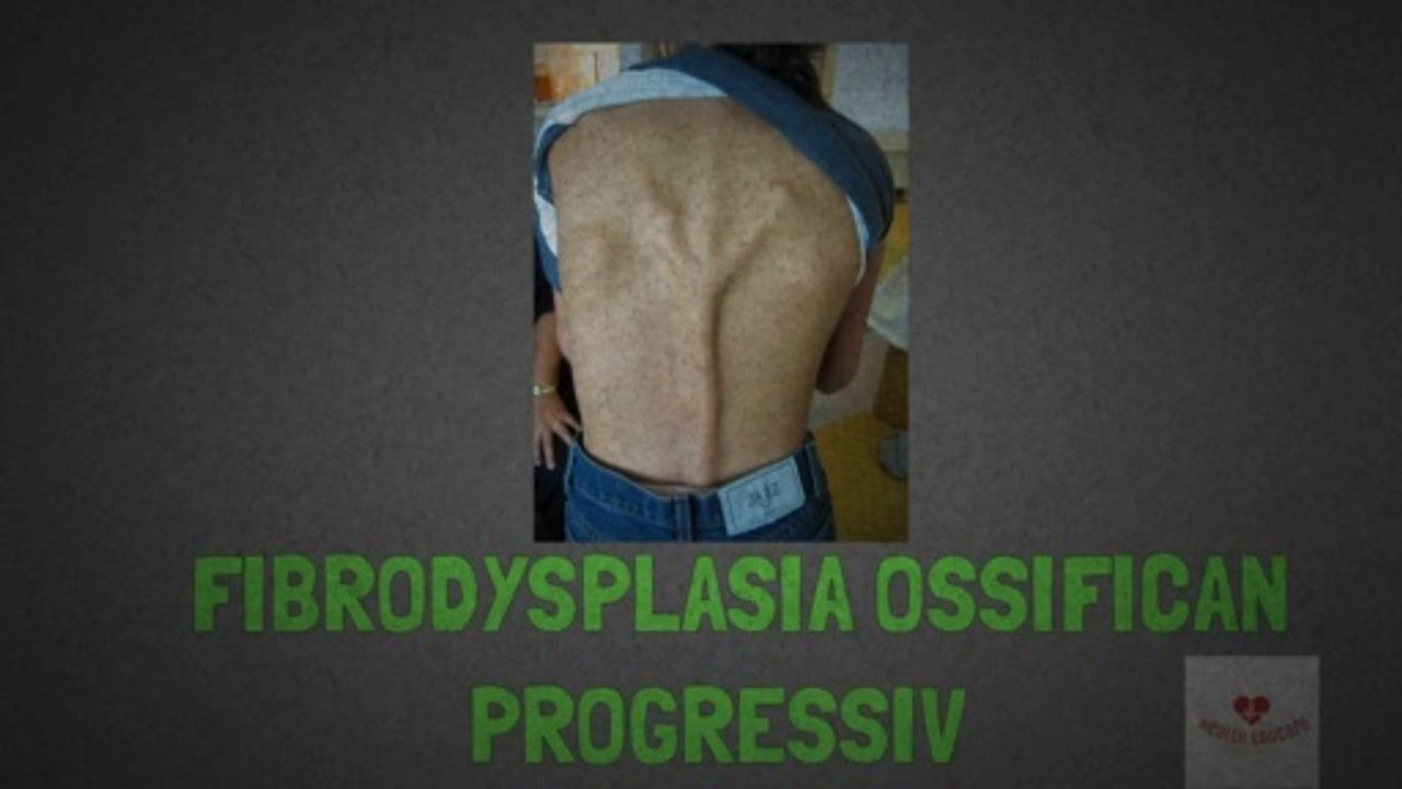 fibrodysplasia ossificans progressiva