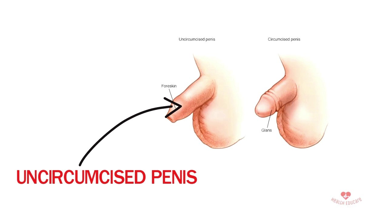 PHIMOSIS: How to pull back your tight foreskin