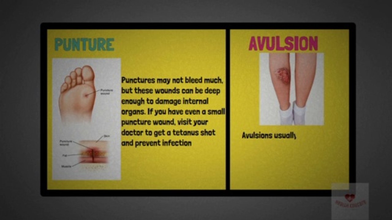 Open Wound- Laceration, Abrasion, Skin Avulsion, Puncture wound